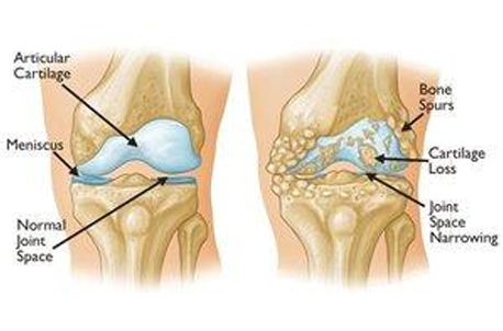 Osteoarthritis